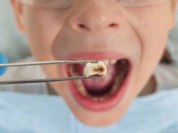 Best Emergency Tooth Extraction in Pine Grove, PA