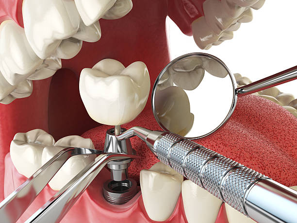 Best Emergency Dental Care for Broken or Chipped Teeth in Pine Grove, PA